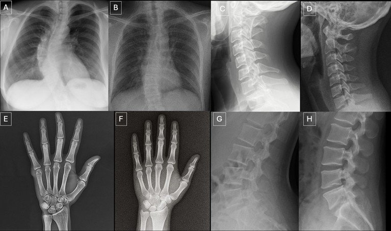A composite image of four anatomy-matched real and GPT-4o-generated radiographs. They show posteroanterior chest, lateral cervical spine, posteroanterior hand, and lateral lumbar spine radiographs.