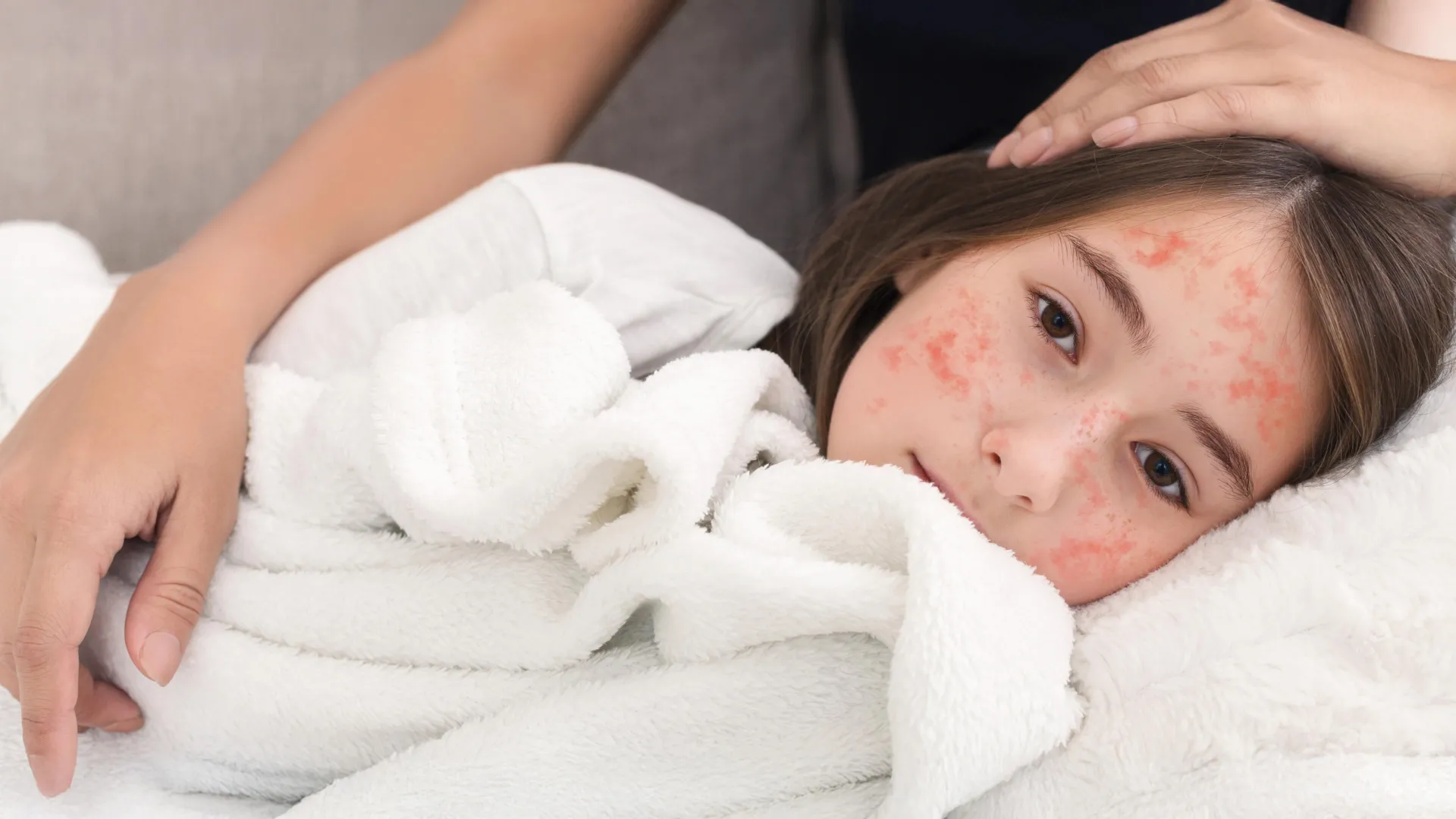 A new antiviral could stop measles before an outbreak takes off