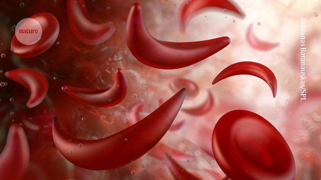 Sickle-cell disease linked to prematurely aged stem cells in mice